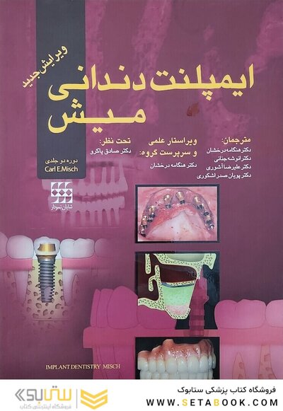 ایمپلنت دندانی میش 1 و 2