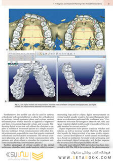 Principles and Biomechanics of Aligner Treatment