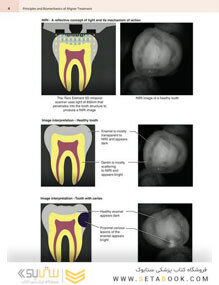 Principles and Biomechanics of Aligner Treatment