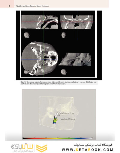 Principles and Biomechanics of Aligner Treatment
