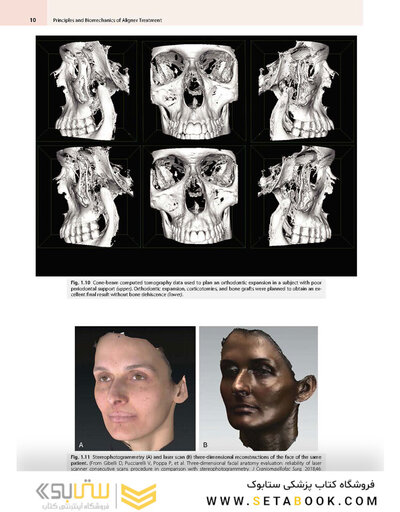 Principles and Biomechanics of Aligner Treatment