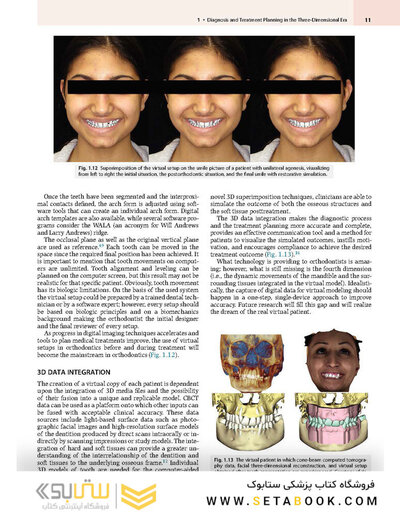 Principles and Biomechanics of Aligner Treatment