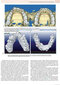 Principles and Biomechanics of Aligner Treatment