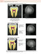 Principles and Biomechanics of Aligner Treatment