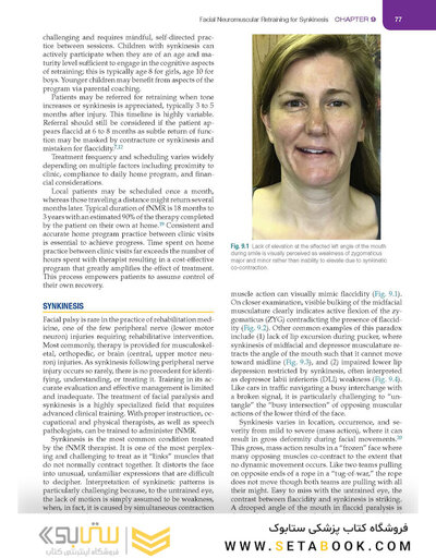 Management of Post-Facial Paralysis Synkinesis