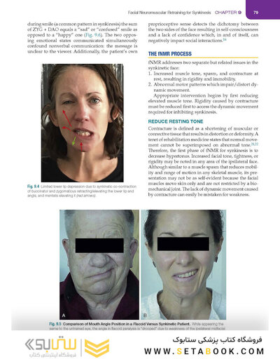 Management of Post-Facial Paralysis Synkinesis