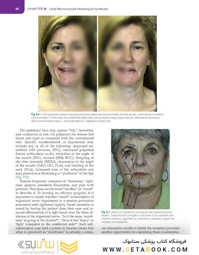 Management of Post-Facial Paralysis Synkinesis