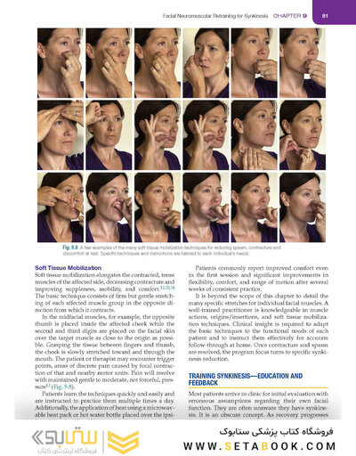 Management of Post-Facial Paralysis Synkinesis