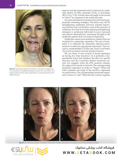 Management of Post-Facial Paralysis Synkinesis