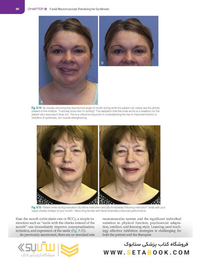 Management of Post-Facial Paralysis Synkinesis