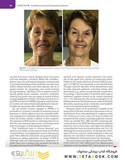 Management of Post-Facial Paralysis Synkinesis