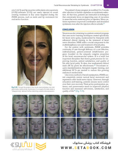 Management of Post-Facial Paralysis Synkinesis