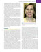 Management of Post-Facial Paralysis Synkinesis