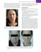 Management of Post-Facial Paralysis Synkinesis