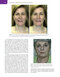 Management of Post-Facial Paralysis Synkinesis