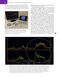 Management of Post-Facial Paralysis Synkinesis