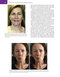Management of Post-Facial Paralysis Synkinesis