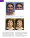 Management of Post-Facial Paralysis Synkinesis