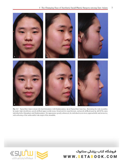 Aesthetic Plastic Surgery of the East Asian Face