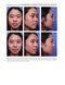 Aesthetic Plastic Surgery of the East Asian Face