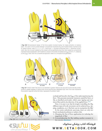 Temporary Anchorage Devices in Orthodontics 2nd Edition 2021
