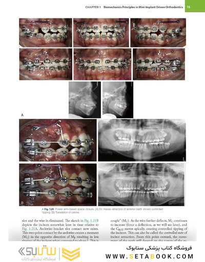 Temporary Anchorage Devices in Orthodontics 2nd Edition 2021