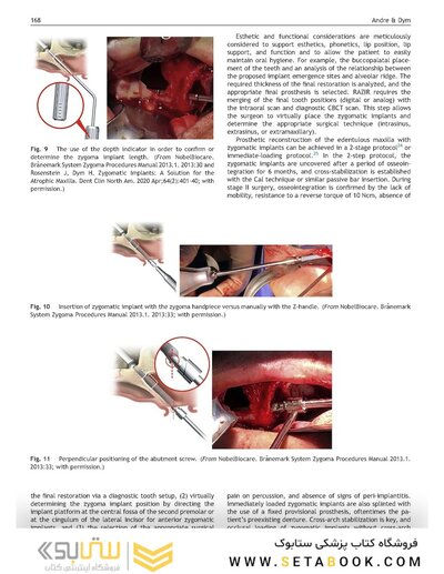 Perspectives on Zygomatic Implants, An Issue of Atlas of the Oral & Maxillofacial Surgery Clinics: Volume 29-2