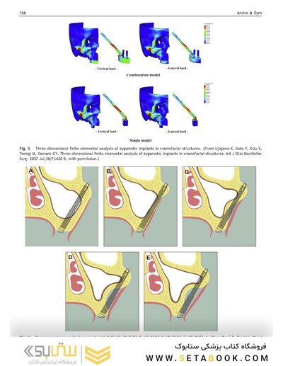 Perspectives on Zygomatic Implants, An Issue of Atlas of the Oral & Maxillofacial Surgery Clinics: Volume 29-2