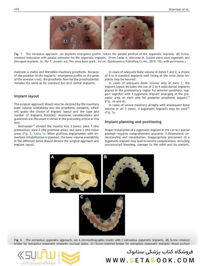 Perspectives on Zygomatic Implants, An Issue of Atlas of the Oral & Maxillofacial Surgery Clinics: Volume 29-2
