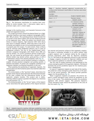 Perspectives on Zygomatic Implants, An Issue of Atlas of the Oral & Maxillofacial Surgery Clinics: Volume 29-2
