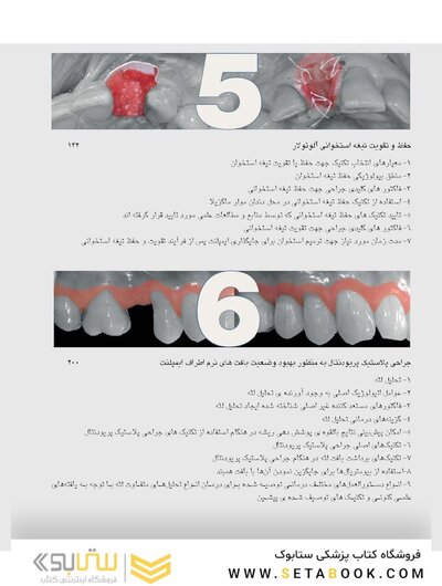 زیبایی شناسی بافت نرم و پرسلن های صورتی رنگ در درمان با ایمپلنت