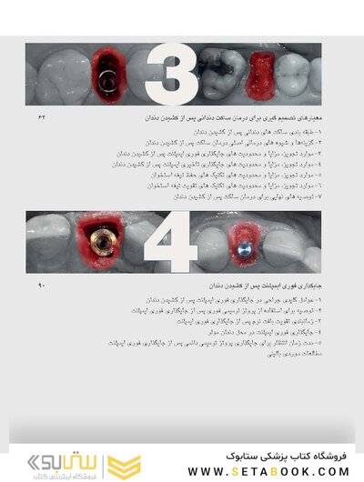 زیبایی شناسی بافت نرم و پرسلن های صورتی رنگ در درمان با ایمپلنت
