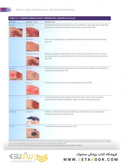 Wound, Ostomy, and Continence Nurses Society Core Curriculum: Wound Management Second, North American Edición