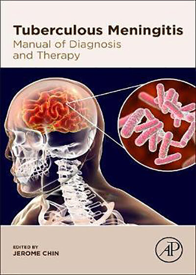 Tuberculous-Meningitis2020 مننژیت سل