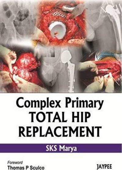 Complex Primary Total Hip Replacement 1st Edition