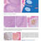 Atlas of Differential Diagnosis in Neoplastic Hematopathology2021