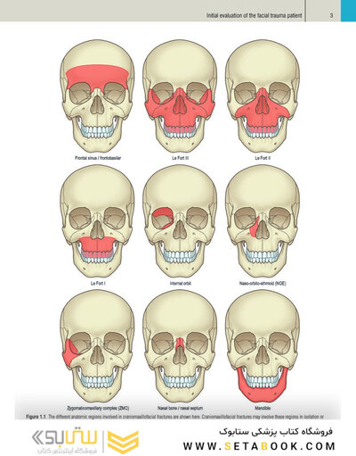 Plastic Surgery Neligan Volume 3: Craniofacial, Head and Neck Surgery and Pediatric Plastic Surgery 5th Edition 2023
