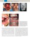 Plastic Surgery Neligan Volume 3: Craniofacial, Head and Neck Surgery and Pediatric Plastic Surgery 5th Edition 2023
