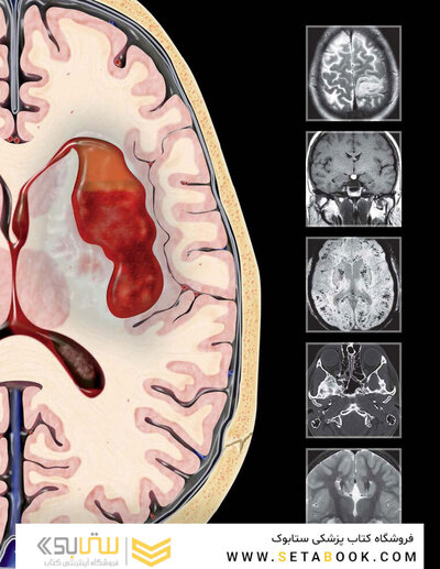 Osborn's Brain 3rd Edition