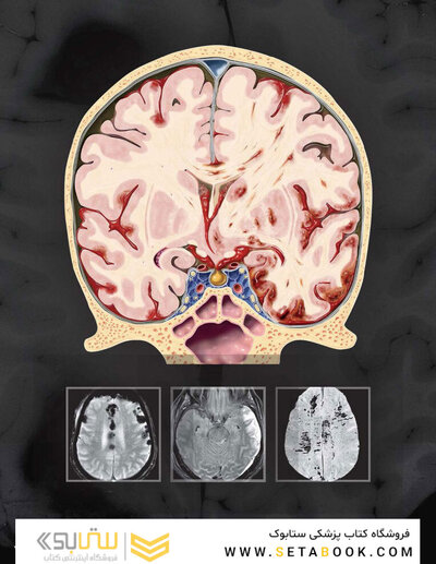 Osborn's Brain 3rd Edition