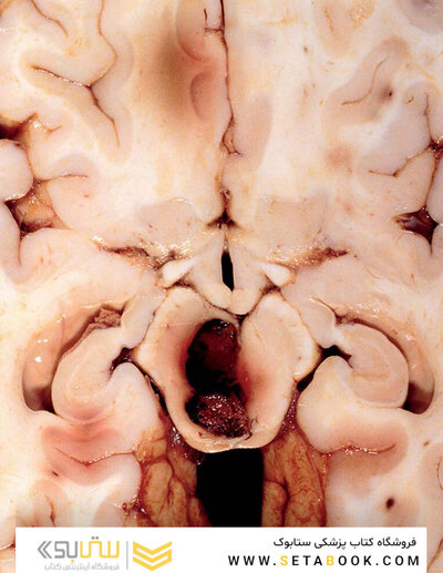 Osborn's Brain 3rd Edition