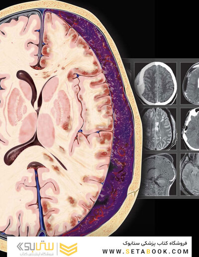 Osborn's Brain 3rd Edition