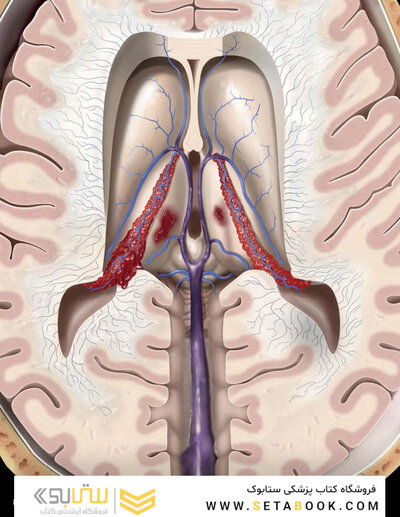 Osborn's Brain 3rd Edition
