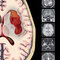 Osborn's Brain 3rd Edition