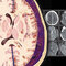 Osborn's Brain 3rd Edition