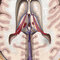 Osborn's Brain 3rd Edition