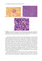 2024-2025 Basic and Clinical Science Course, Section 4: Ophthalmic Pathology and Intraocular Tumors