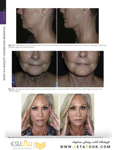 The Art and Science of Facelift Surgery 2nd Edition 2024