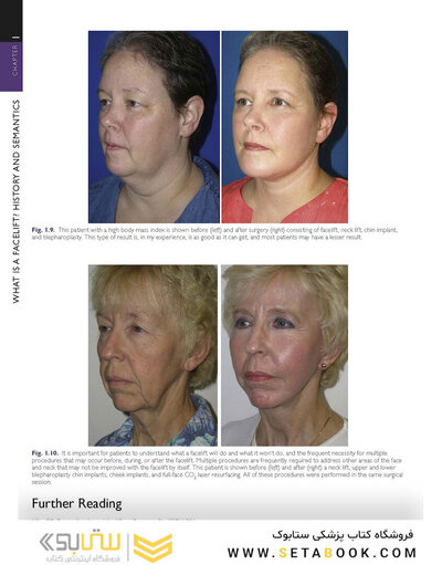 The Art and Science of Facelift Surgery 2nd Edition 2024