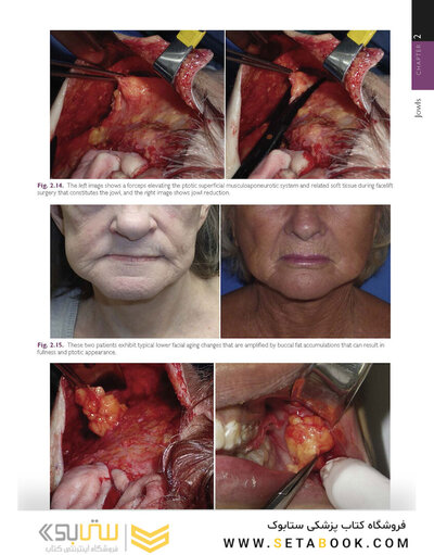 The Art and Science of Facelift Surgery 2nd Edition 2024